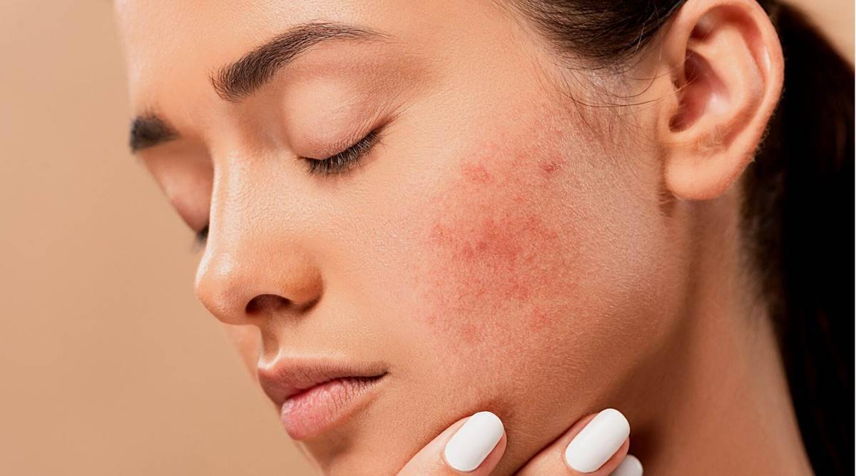 Acne Treatment in bangalore