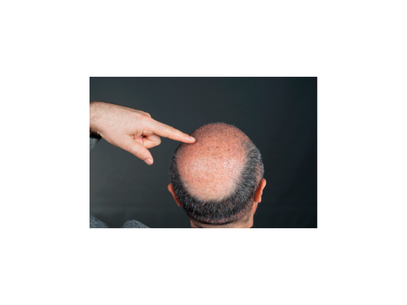 Why You Might Need Hair Transplant Surgery?