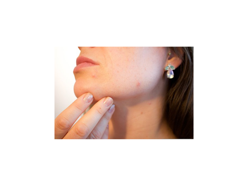 Acne Treatment in bangalore